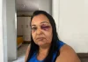 Mulher atropelada na faixa de pedestres em Colatina fala sobre o acidente